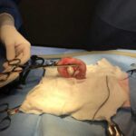 Laparoscopic assisted intestinal biopsy