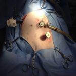 Port placement for laparoscopic assisted gastropexy
